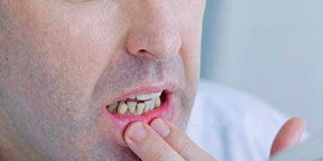 Oral-Ulcer-Clinic